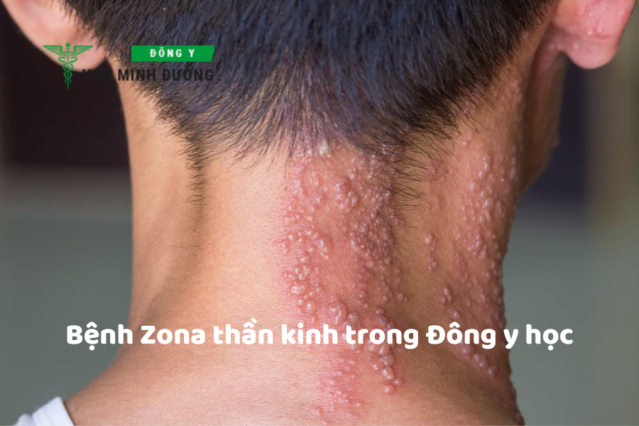 Bệnh Zona thần kinh trong Đông y học
