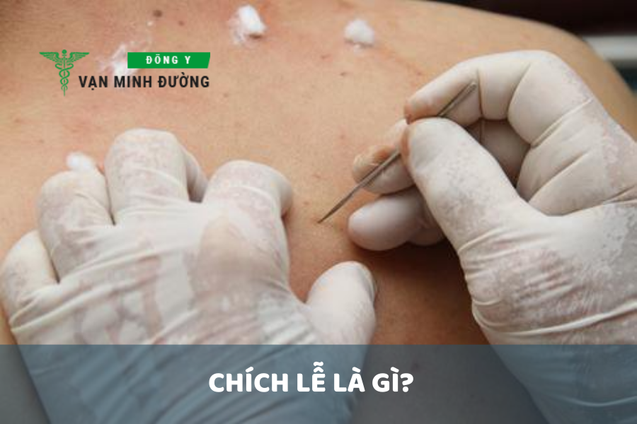Chích lể là gì?