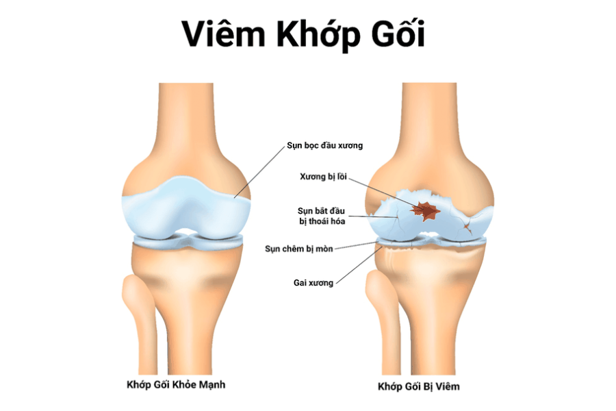 các bệnh thường gặp ở khớp gối