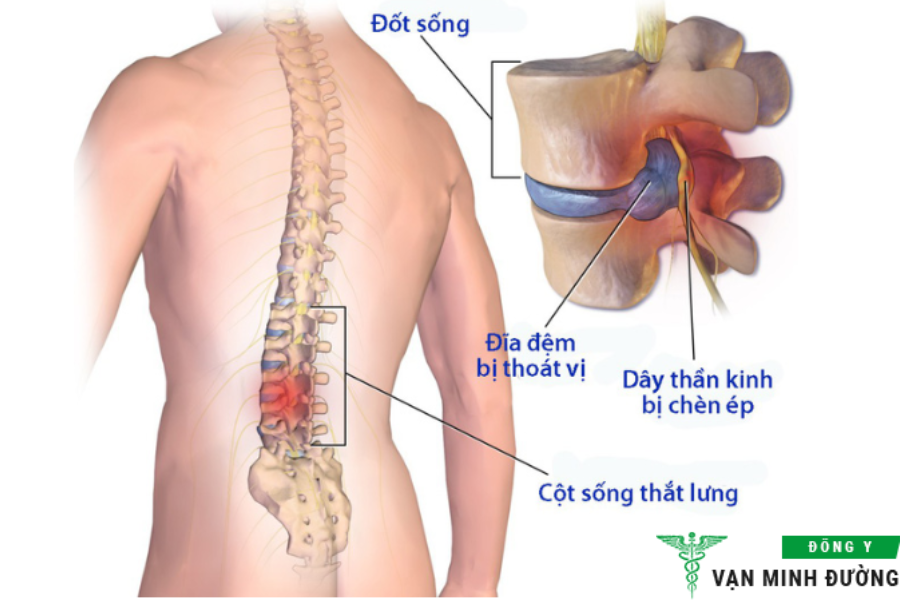 bệnh ở cột sống