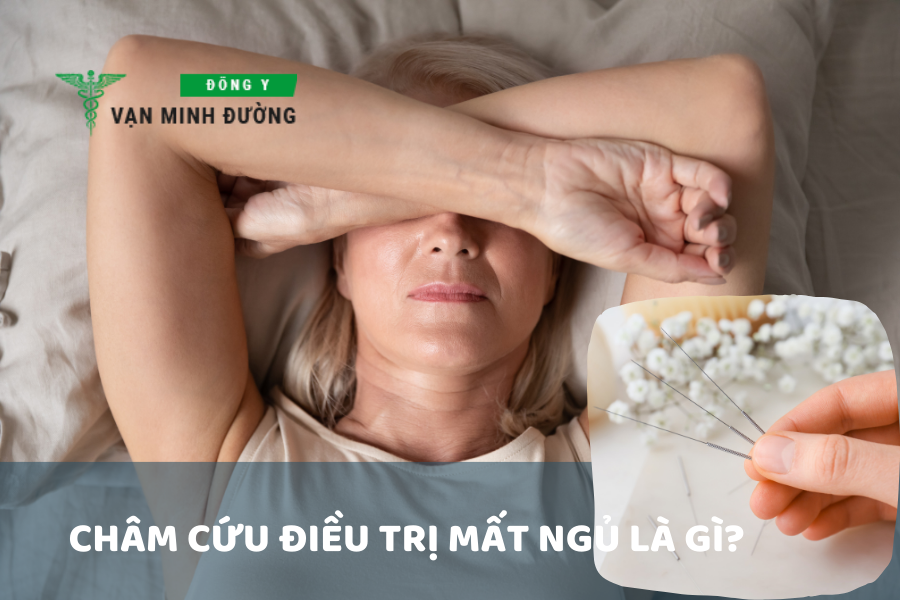 Chữa mất ngủ bằng phương pháp châm cứu là gì