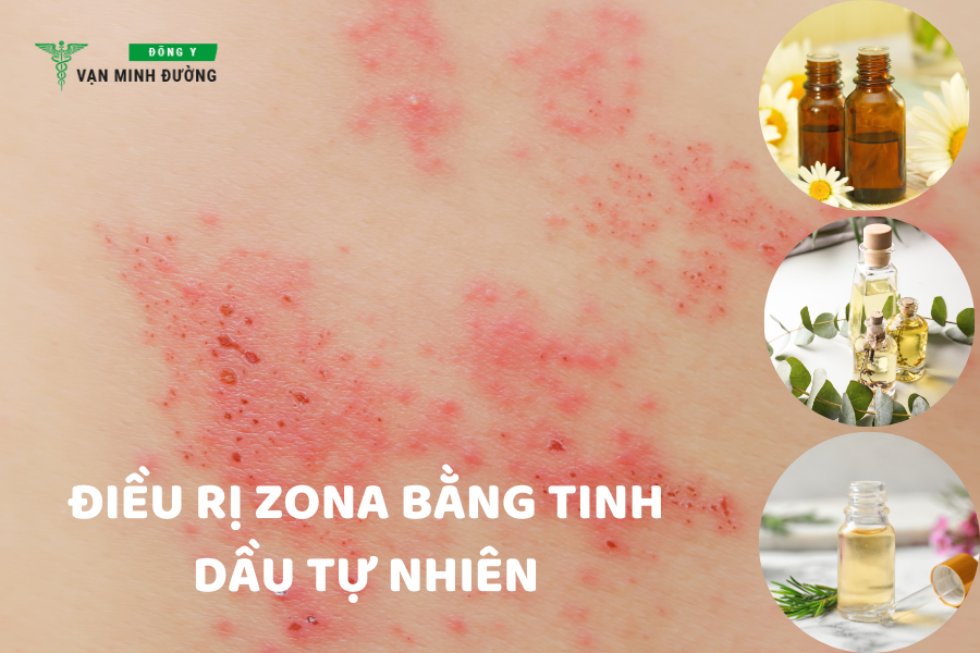 Điều trị zona thần kinh bằng tinh dầu