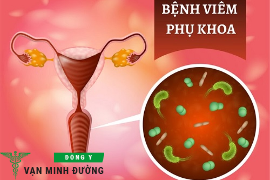 viêm nhiễm phụ khoa