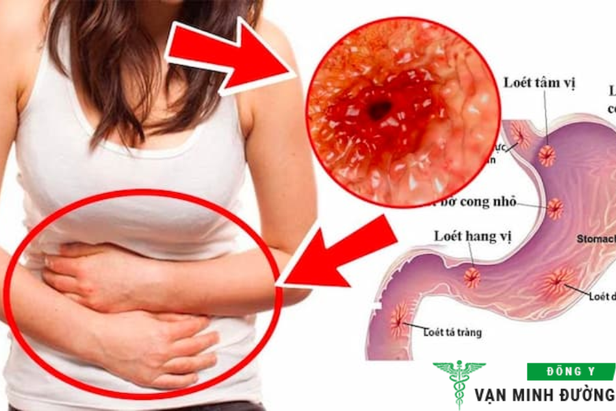 bệnh viêm dạ dày
