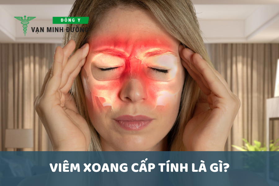 Viêm xoang cấp tính là gì