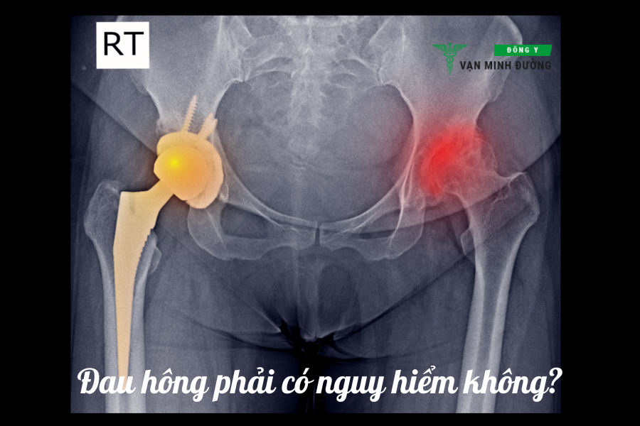 Đau hông bên phải có nguy hiểm không