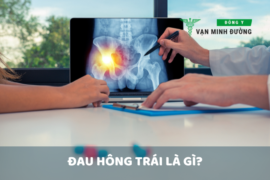 Đau hông trái là gì?